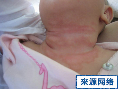 夏季儿童保健 夏季儿童湿疹应注意什么 儿童湿疹怎么办